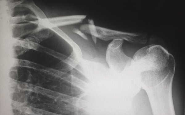 Fractures osseuses: Solutions pour guérir et prévenir avec efficacité